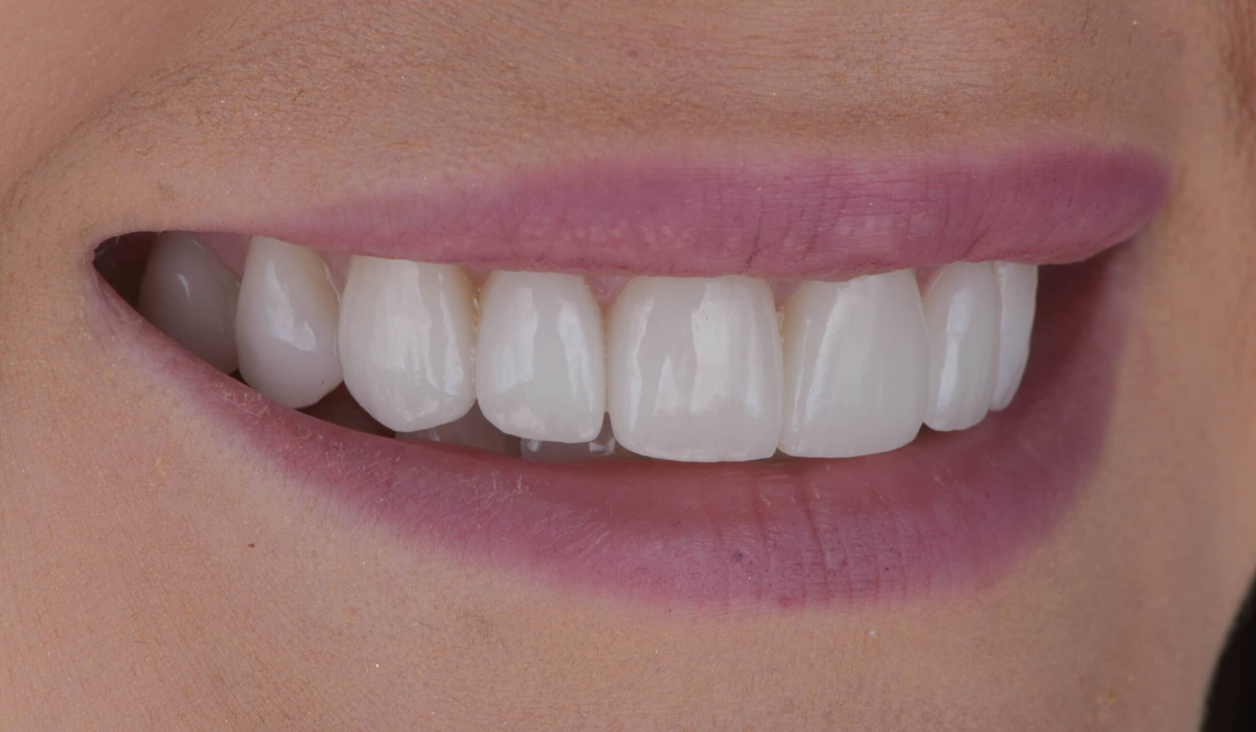 Post-treatment outcome showing harmonious golden proportions, lifelike ceramic translucency, and natural shade match
