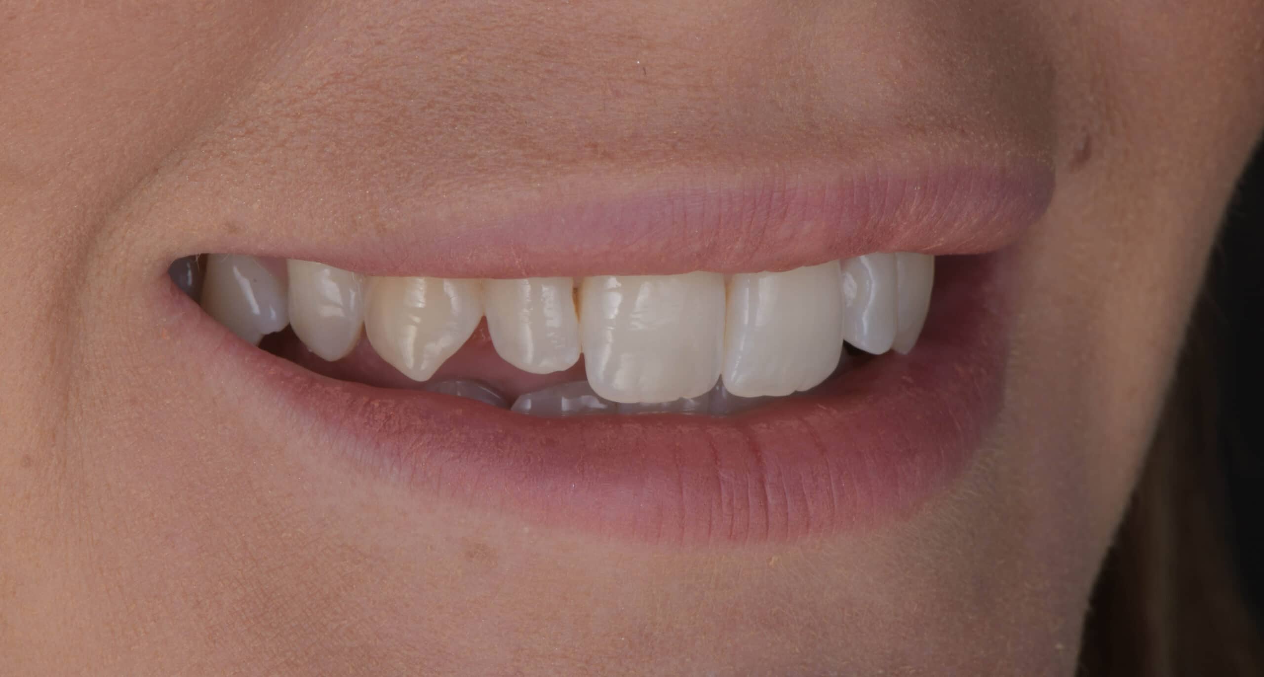 Pre-treatment view of uneven incisal edges, discolouration, and narrow smile before ceramic veneers