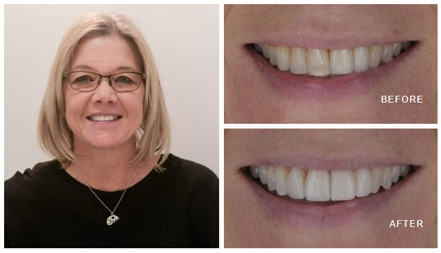 Single anterior dental implant tooth replacement seamlessly colour matched