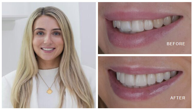 Ceramic Veneers before and after showing correction of discoloured enamel and spacing