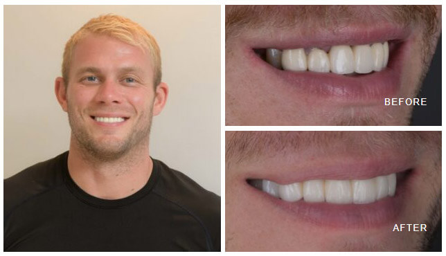 Full mouth aesthetic rehabilitation restoring bite vertical dimension and smile symmetry