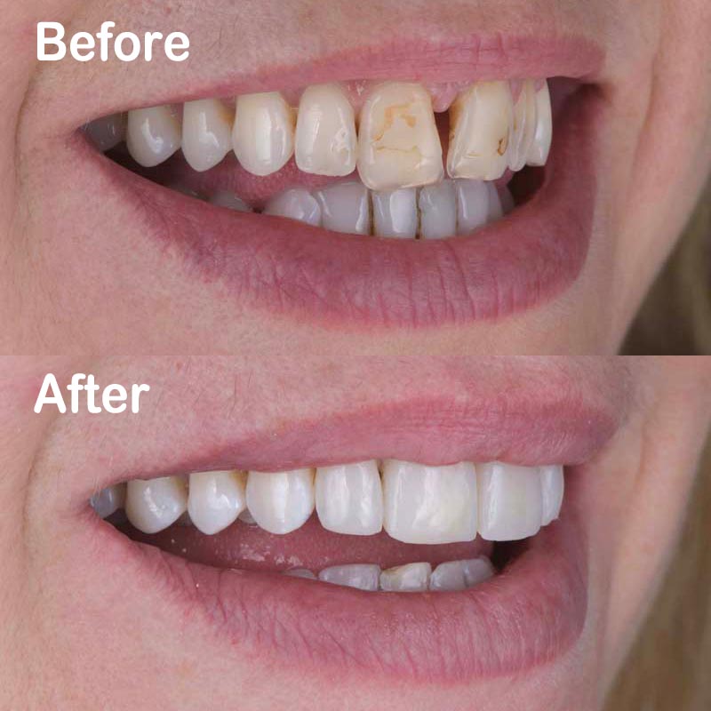 Direct composite bonding repairing fractured chipped front teeth chairside