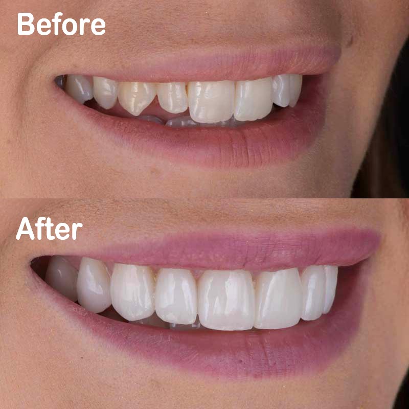 Hand-crafted ceramic and porcelain veneers on dental cast model