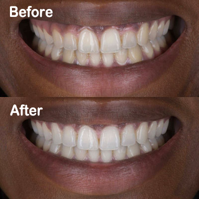 Gummy Smile Makeover before and after showing laser gum lift and tooth lengthening