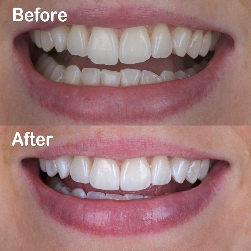 Mini Smile Makeover clinical before and after outcome after contouring and whitening