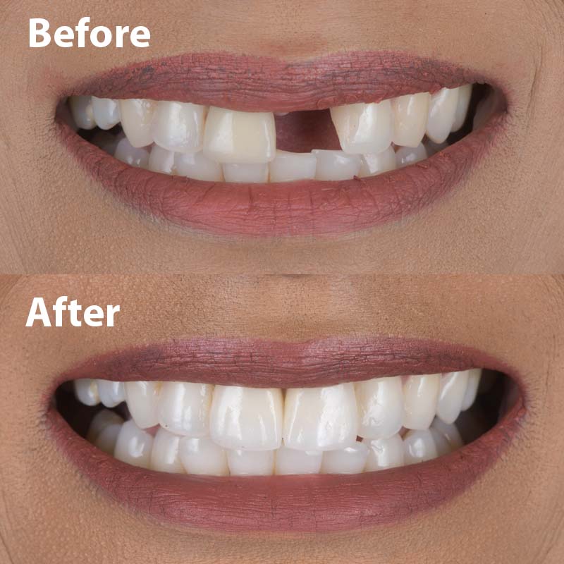 Precision Swiss Straumann dental implant fixture and custom ceramic crown